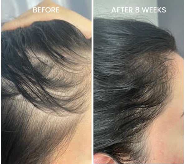Before and after hairline results after 8 weeks