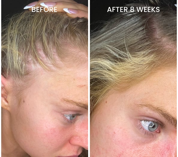 Before and after thin spots regrowth after 8 weeks