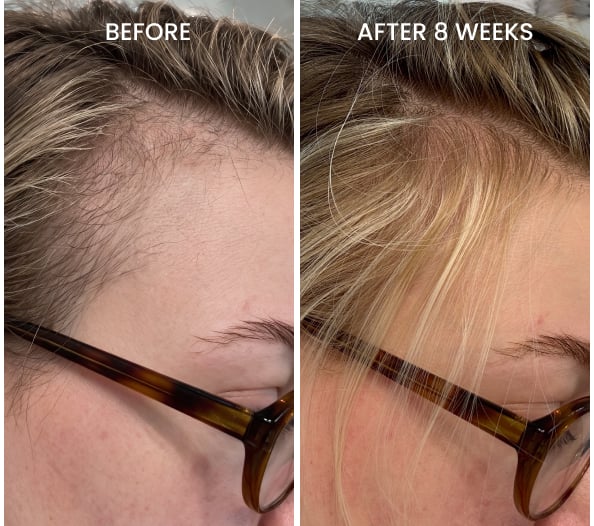 Before and after postpartum hair results after 8 weeks